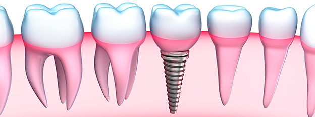 Dental Implants